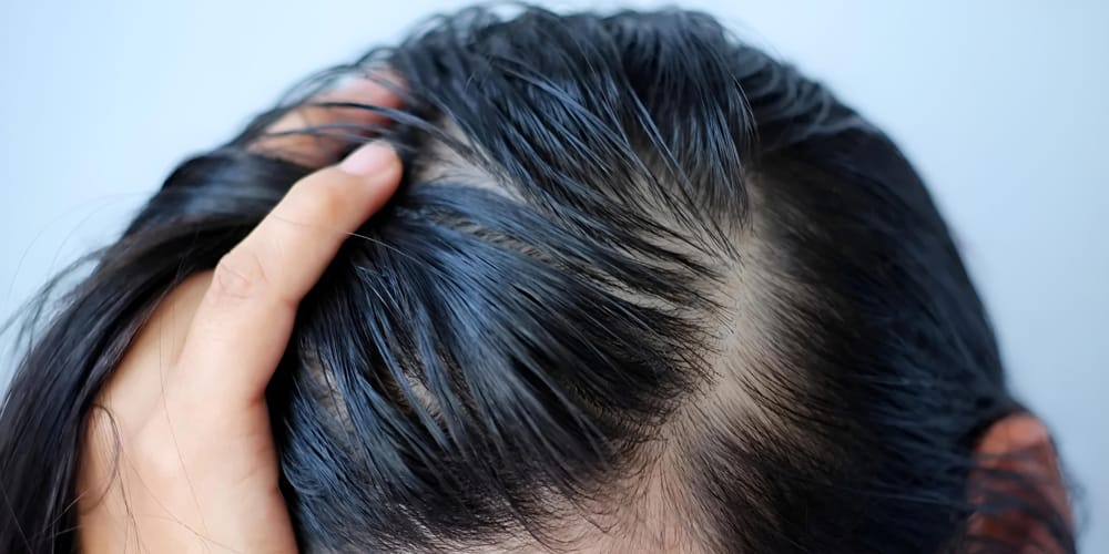ریزش مو بر اثر چربی پوست سر