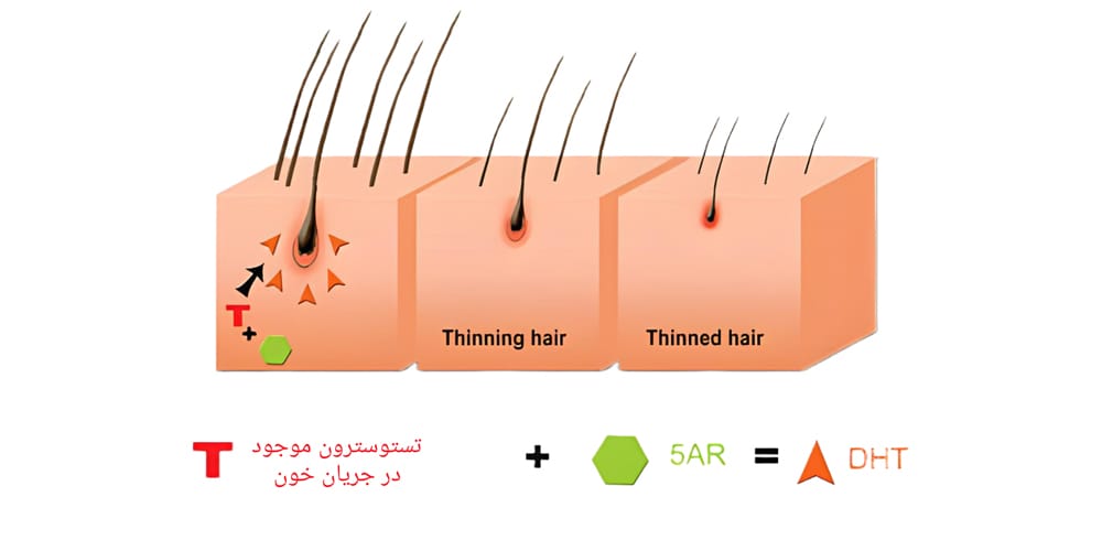 ریزش DHT